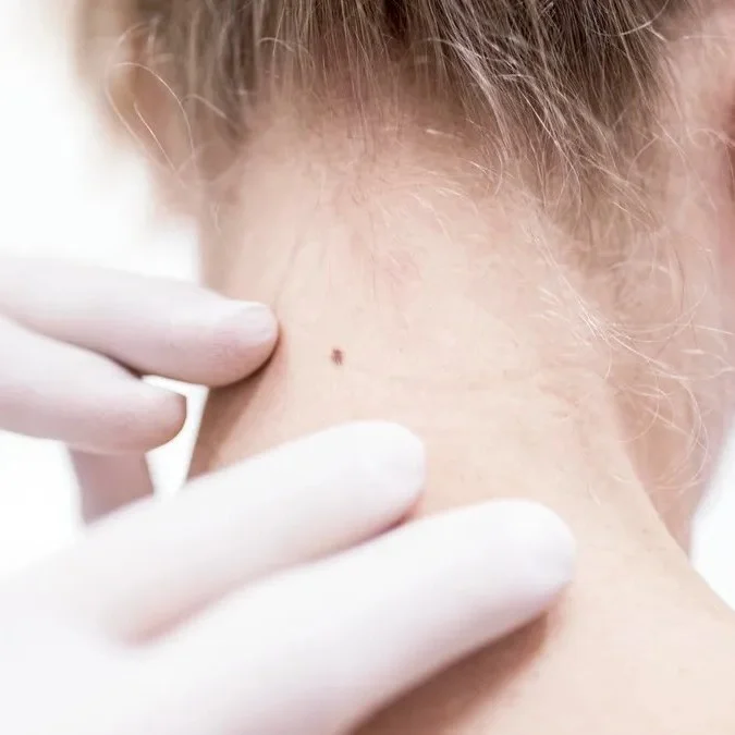 Skin Cancer Checks and Treatment Pakenham